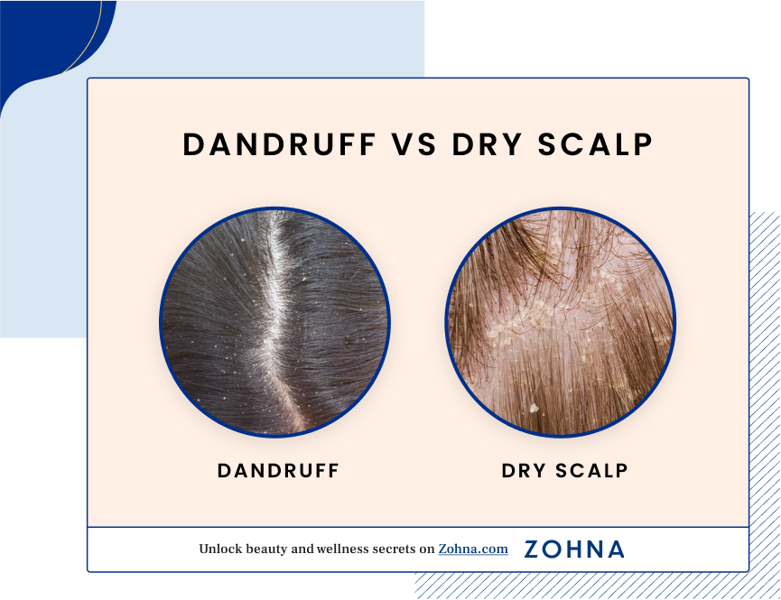 Dandruff vs Dry Scalp
