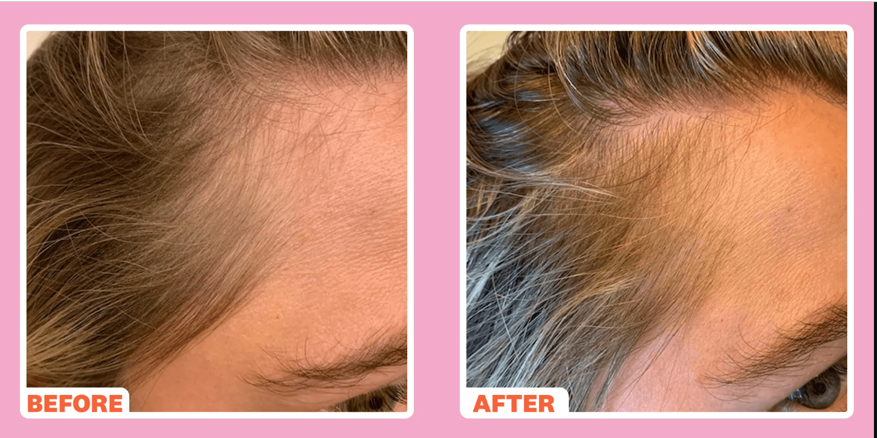 Derma Roller Results Hair