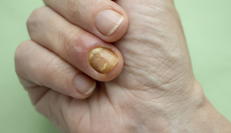 Fingernail Fungus From Acrylic Nails – Prevention, Treatment, Pics & More
